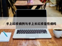 手上红疹病例与手上长红疹是性病吗